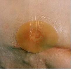 MEDICAZIONE IDROCOLLOIDALE TEGADERM HYDROCOLLOID THIN QUADRATA SENZA BORDO 10X10CM 5 PEZZI - Farmaciapacini.it